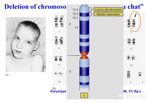 21 18 13号染色体分别代表什么